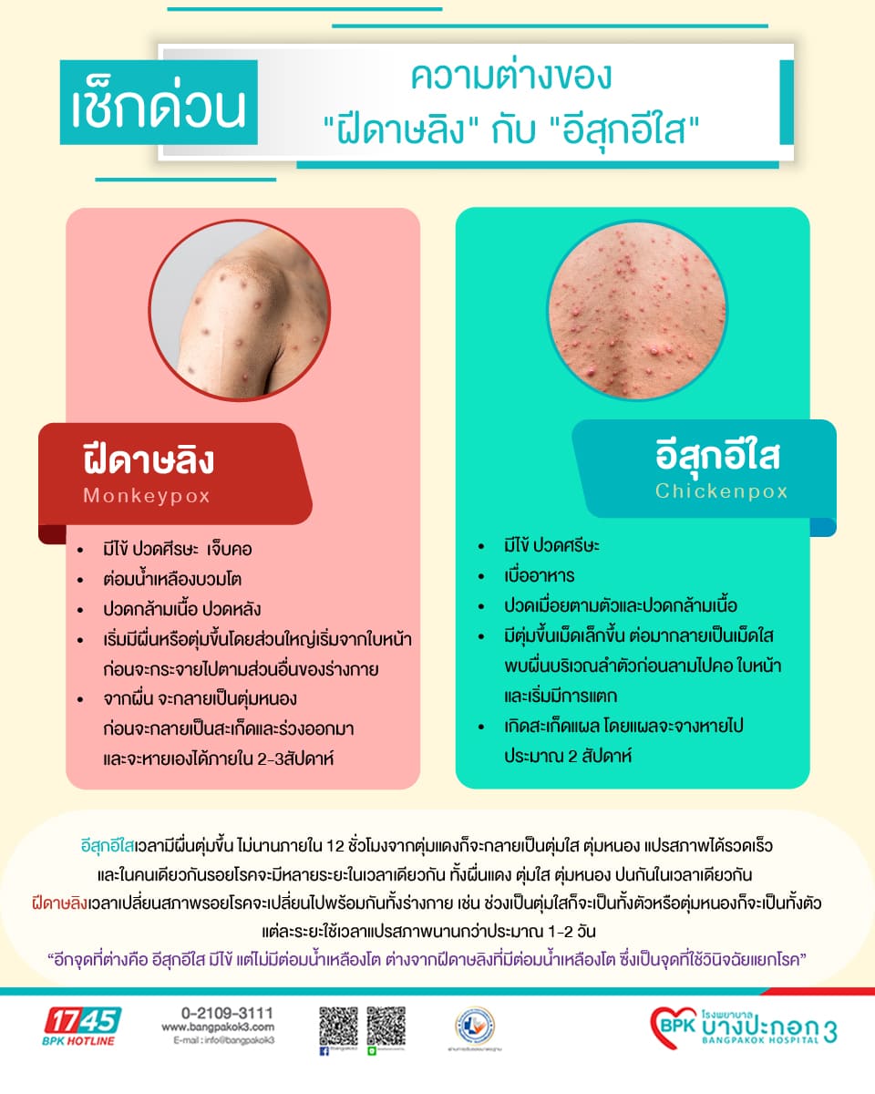 อาการคืออะไร? ติดง่ายขึ้นจริงไหม? ชวนรู้จัก โรคฝีดาษลิงสายพันธุ์ Clade 1b  ที่เสี่ยงแพร่กระจายไปทั่วโลก, image size:960x1200